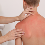 A child undergoing pediatric care for sunburn.