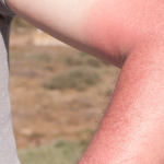 Sunburn pediatrics advice