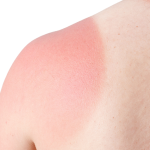 sunburn tips PHCA