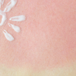 Sunburn issues PHCA Tips