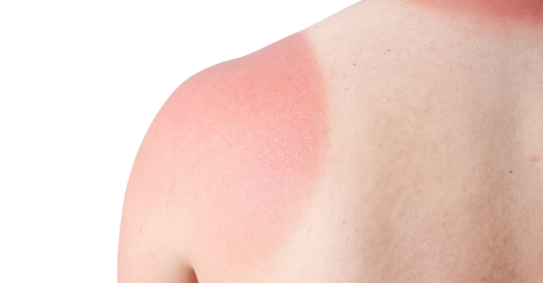 Recognizing and Treating Sunburn: A Guide for Parents and Caregivers
