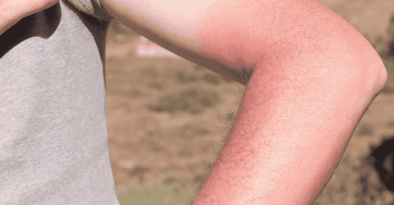 Sunburn in Children: What Every Parent Needs to Know About Symptoms and Early Care