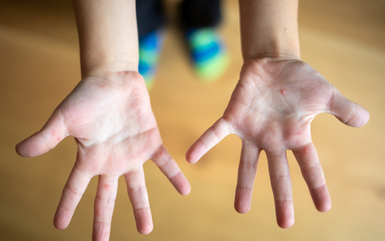 Hand, Foot, and Mouth Disease: The Back-to-School Rash Altoona Parents Are Asking About
